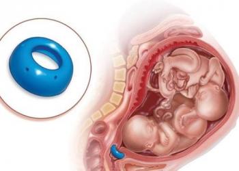 Pessário durante a gravidez: o que é, por que usar