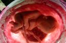 Doğuşdan əvvəl suyun necə qırılması Hamiləlik zamanı amniotik mayenin testləri