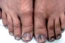 Надлъжни ивици по ноктите: причини и методи за лечение Кафяви ивици по ноктите като треска