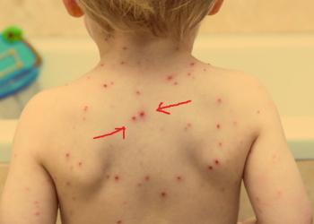 Какви заболявания причиняват червени петна по кожата?